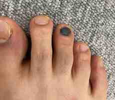 足の爪が内出血で黒ずみ治らない 悪性黒色腫との違いは 医療 福井のニュース 福井新聞online