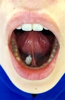 花粉症の舌下免疫療法では、フリーズドライ加工した錠剤（写真中央）を口に含む方法が主流になりつつあるという（福井大学医学部耳鼻咽喉科提供）